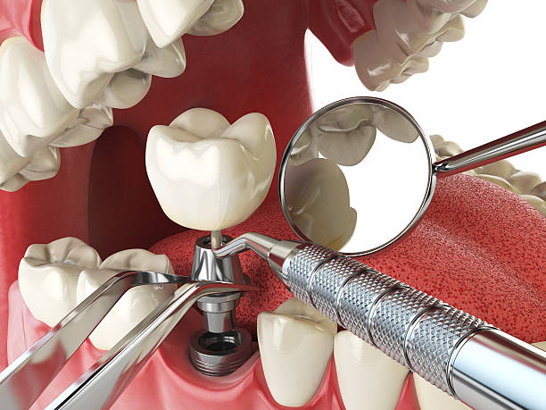 Best Emergency Root Canal Treatment in Kerman, CA