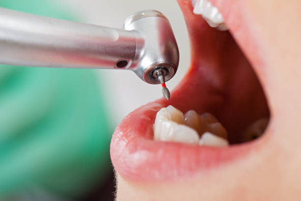 Best Emergency Dentist for Lost Fillings or Crowns in Kerman, CA